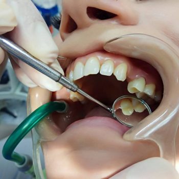 Когда не хочется спиливать оставшуюся часть зуба под коронку, а реставрация будет не самым правильным решением - вкладка Е-Max, новые технологии.